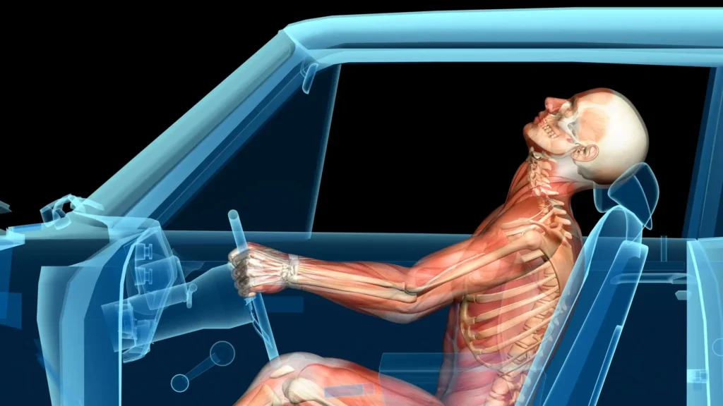 Whiplash After a Car Accident? Here&rsquo;s What You Need to Know